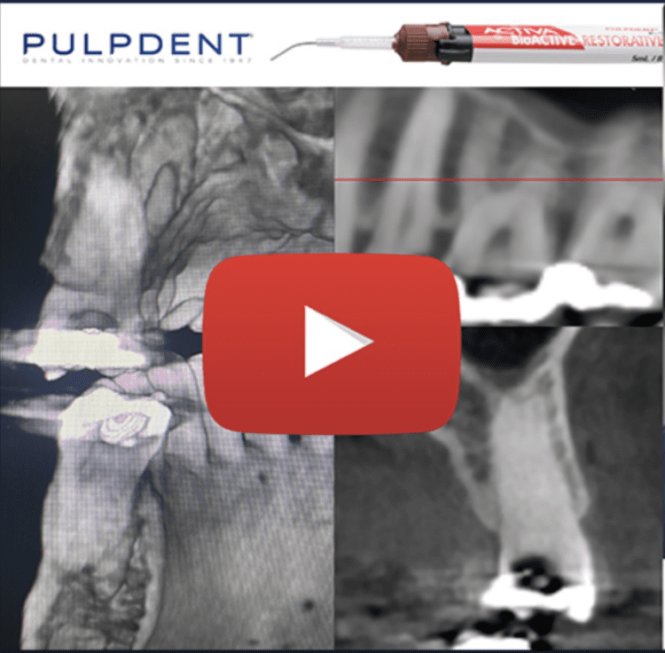 Read more about the article The Deep Margin Elevation Technique