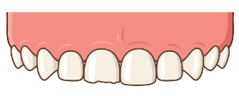 Strip Crown Figure 1