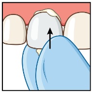 Strip Crown Figure 5