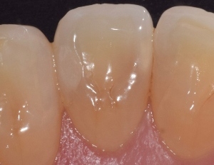 Read more about the article Use of Bioactive Restorative Materials in Patients with High Caries Risk