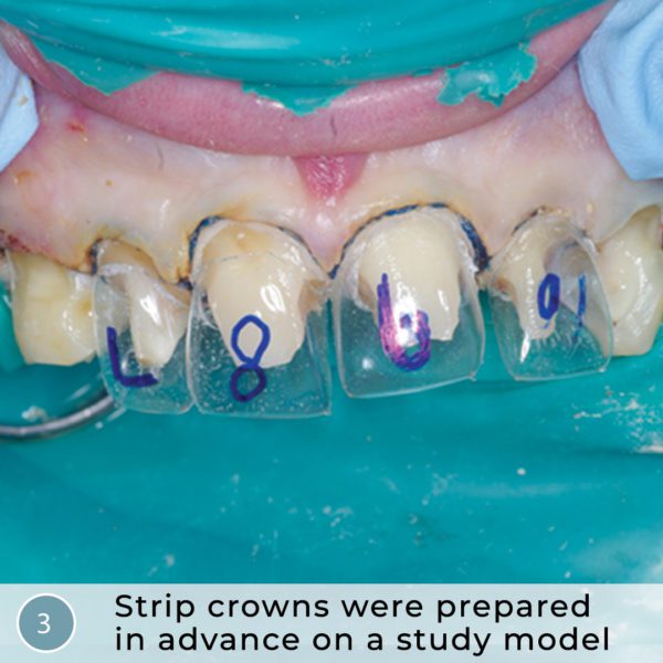 Heroic Dentistry Severe Autism, Rampant Caries, Strip Crowns and ACTIVA BioACTIVERESTORATIVE